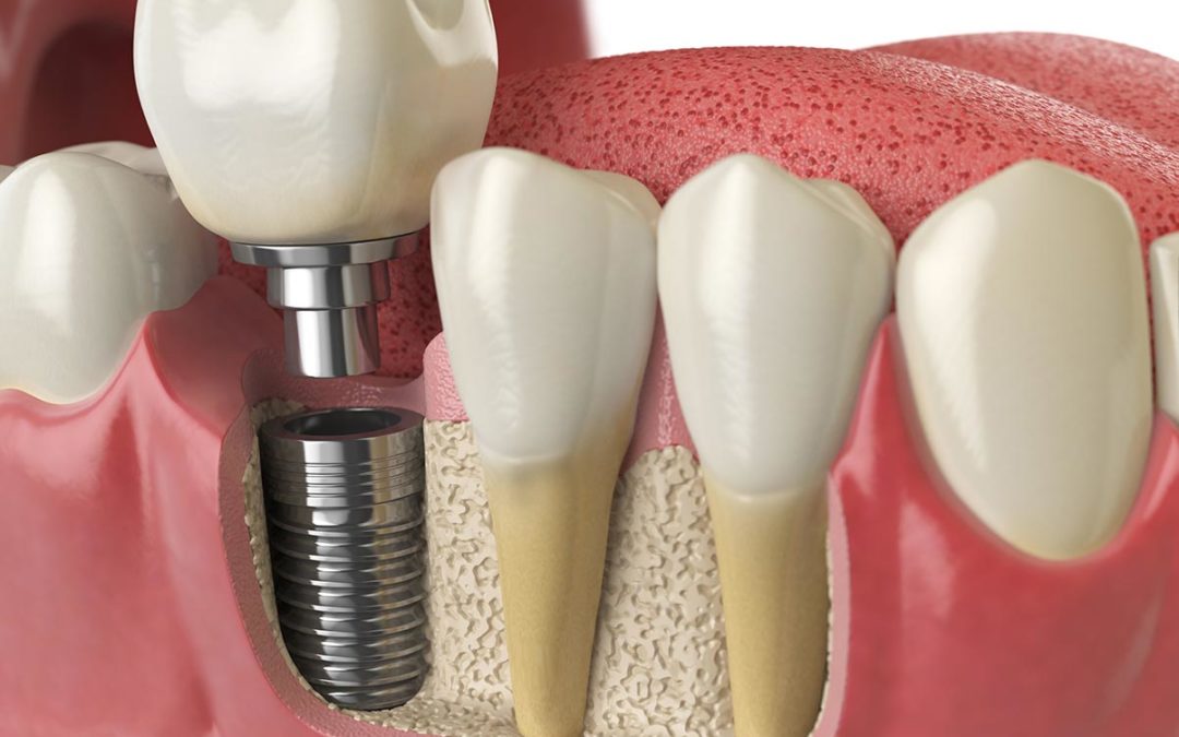 What is involved in the placement of my dental implant?