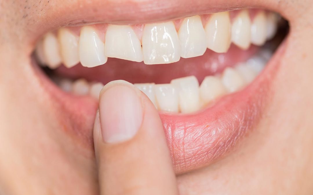 Repair of Fractured Teeth