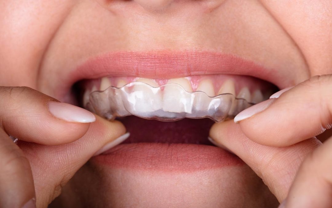 Teeth Grinding (Bruxism)