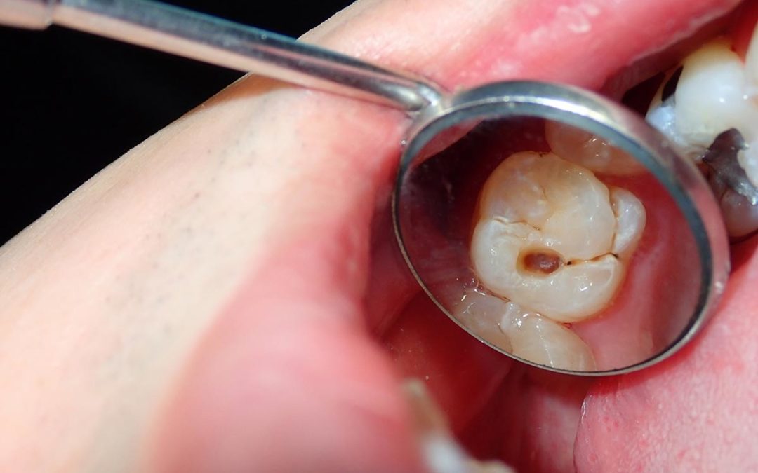 cavities-and-tooth-decay-dr-soon