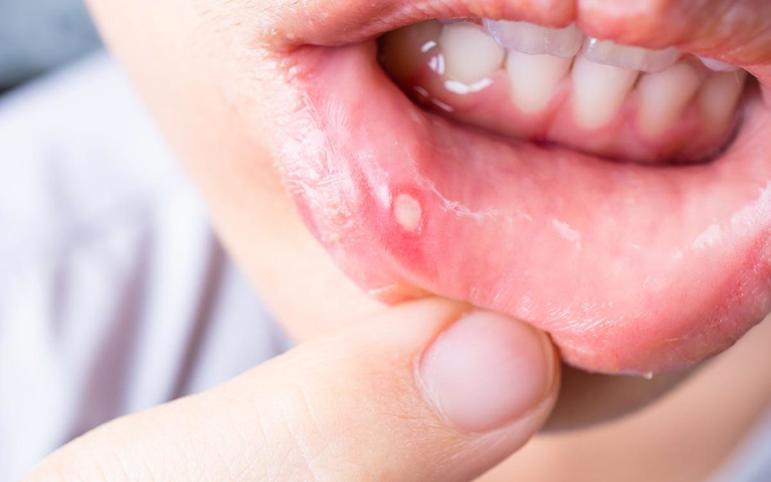 Canker/Cold Sores