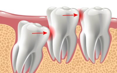 Wisdom Teeth